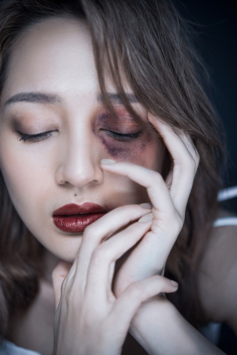 Nữ ca sĩ Bảo Anh và con mắt bầm tím - Ảnh 2. Nữ ca sĩ Bảo Anh và con mắt bầm tím - Ảnh 2.