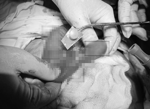 Uống thuốc quên bóc vỏ, một F0 bị thủng ruột phải nhập viện cấp cứu - Ảnh 1. Uống thuốc quên bóc vỏ, một F0 bị thủng ruột phải nhập viện cấp cứu - Ảnh 1.