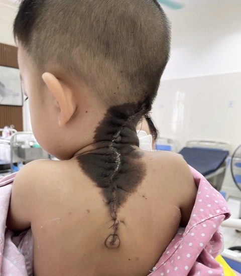 Bé trai có mảng da màu đen giống như ‘bớt’, bác sĩ chẩn đoán mắc Nevus - Ảnh 2. Bé trai có mảng da màu đen giống như ‘bớt’, bác sĩ chẩn đoán mắc Nevus - Ảnh 2.