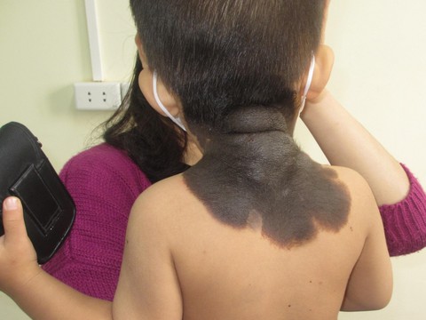 Bé trai có mảng da màu đen giống như ‘bớt’, bác sĩ chẩn đoán mắc Nevus - Ảnh 1. Bé trai có mảng da màu đen giống như ‘bớt’, bác sĩ chẩn đoán mắc Nevus - Ảnh 1.