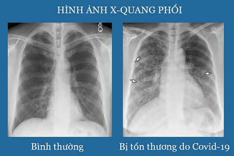 Tại sao nên phòng ngừa di chứng hậu COVID-19? - Ảnh 1. Tại sao nên phòng ngừa di chứng hậu COVID-19? - Ảnh 1.