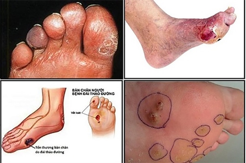 Tìm hiểu các loại biến chứng mãn tính của bệnh tiểu đường - Ảnh 2.