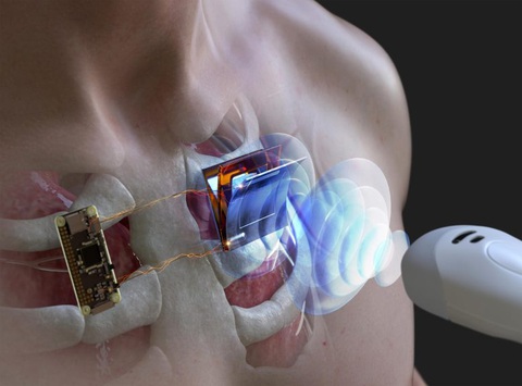 Nghiên cứu mới giúp sạc pin máy tạo nhịp tim mà không cần phẫu thuật - Ảnh 1. Nghiên cứu mới giúp sạc pin máy tạo nhịp tim mà không cần phẫu thuật - Ảnh 1.