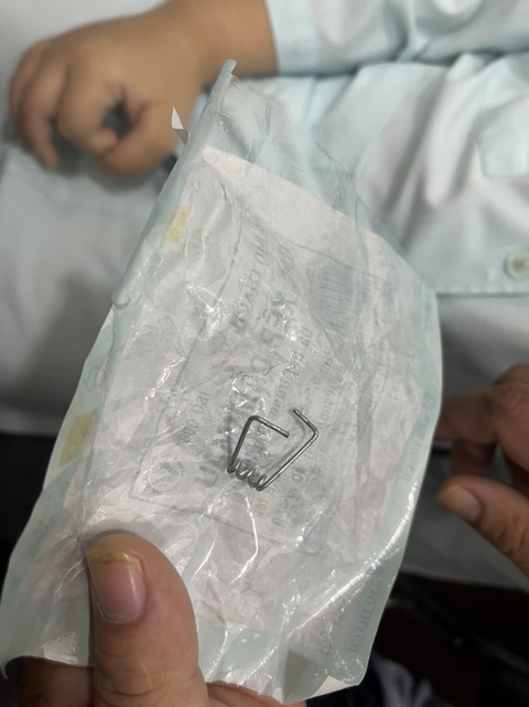 Lấy lò xo có hai càng nhọn dài 3cm trong thành họng của bé trai - Ảnh 1. Lấy lò xo có hai càng nhọn dài 3cm trong thành họng của bé trai - Ảnh 1.