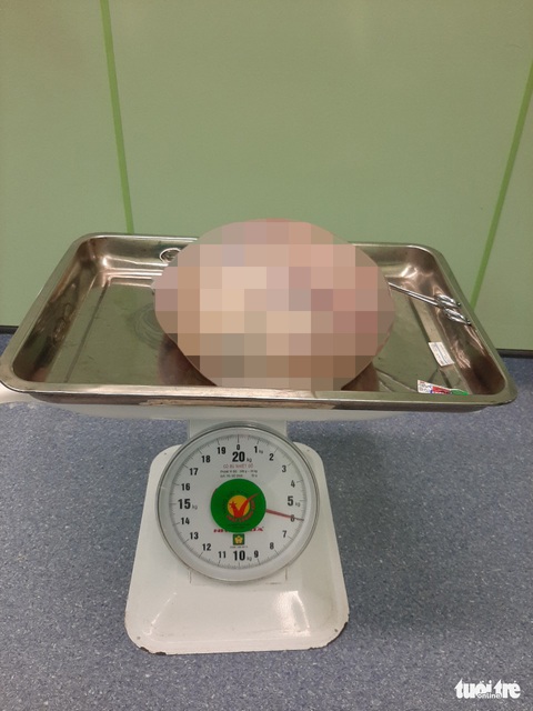 Mang khối u buồng trứng 6kg, người phụ nữ 66 tuổi nghĩ… mỡ bụng - Ảnh 2. Mang khối u buồng trứng 6kg, người phụ nữ 66 tuổi nghĩ… mỡ bụng - Ảnh 2.