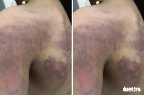 Tạm dừng đứng lớp cô giáo đánh học sinh lớp 3 bầm tím lưng - Ảnh 1. Tạm dừng đứng lớp cô giáo đánh học sinh lớp 3 bầm tím lưng - Ảnh 1.