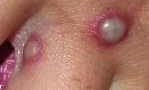 Thêm nhiều quốc gia châu Âu phát hiện các ca mắc đậu mùa khỉ - Ảnh 1. Thêm nhiều quốc gia châu Âu phát hiện các ca mắc đậu mùa khỉ - Ảnh 1.