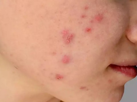 Làm sao nhận biết bệnh đậu mùa khỉ? - Ảnh 1. Làm sao nhận biết bệnh đậu mùa khỉ? - Ảnh 1.