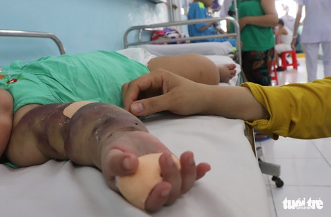Bác sĩ cảnh báo: Trẻ mắc sốt xuất huyết hạ sốt, coi chừng dấu hiệu chuyển nặng - Ảnh 1. Bác sĩ cảnh báo: Trẻ mắc sốt xuất huyết hạ sốt, coi chừng dấu hiệu chuyển nặng - Ảnh 1.