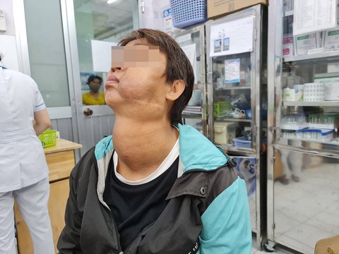 Lấy trọn khối u tuyến giáp dính khối u mạch máu gần nửa ký trên mặt nữ bệnh nhân - Ảnh 1. Lấy trọn khối u tuyến giáp dính khối u mạch máu gần nửa ký trên mặt nữ bệnh nhân - Ảnh 1.