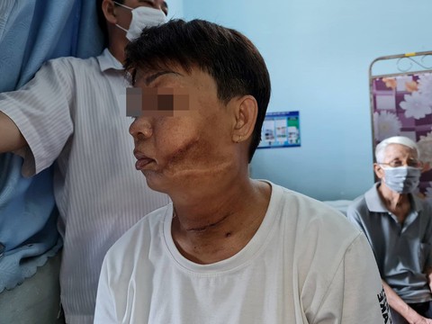 Lấy trọn khối u tuyến giáp dính khối u mạch máu gần nửa ký trên mặt nữ bệnh nhân - Ảnh 2. Lấy trọn khối u tuyến giáp dính khối u mạch máu gần nửa ký trên mặt nữ bệnh nhân - Ảnh 2.
