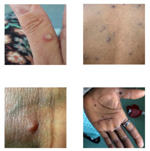 NÓNG: WHO tuyên bố đậu mùa khỉ là tình trạng khẩn cấp y tế toàn cầu - Ảnh 2. NÓNG: WHO tuyên bố đậu mùa khỉ là tình trạng khẩn cấp y tế toàn cầu - Ảnh 2.