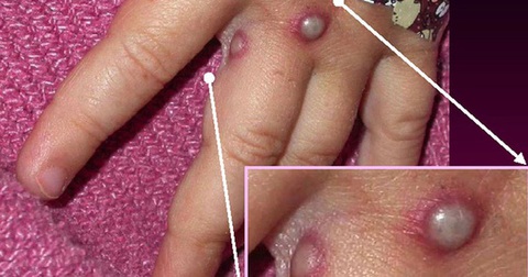 Phòng đậu mùa khỉ, TP.HCM đề xuất cho người nhập cảnh khai báo việc nổi mụn nước, mụn mủ - Ảnh 1. Phòng đậu mùa khỉ, TP.HCM đề xuất cho người nhập cảnh khai báo việc nổi mụn nước, mụn mủ - Ảnh 1.