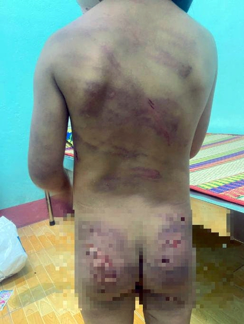 Bé gái 7 tuổi có nhiều vết thương trên người, nghi bị bạo hành - Ảnh 1. Bé gái 7 tuổi có nhiều vết thương trên người, nghi bị bạo hành - Ảnh 1.