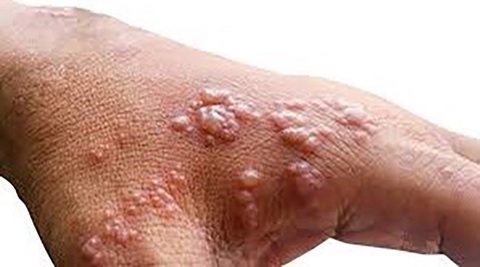 Bị đậu mùa khỉ cách ly tối thiểu 14 ngày khác ra sao với cách ly nhiễm COVID-19? - Ảnh 3. Bị đậu mùa khỉ cách ly tối thiểu 14 ngày khác ra sao với cách ly nhiễm COVID-19? - Ảnh 3.