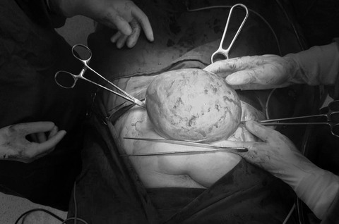 Khối u xơ tử cung lớn như trái bóng sau 6 năm - Ảnh 1. Khối u xơ tử cung lớn như trái bóng sau 6 năm - Ảnh 1.