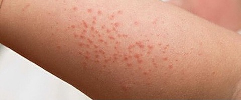 Cảnh giác bệnh sốt xuất huyết giả dạng viêm hô hấp trên - Ảnh 1. Cảnh giác bệnh sốt xuất huyết giả dạng viêm hô hấp trên - Ảnh 1.