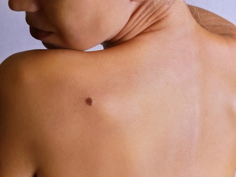 Biến đổi khí hậu khiến người mắc ung thư da tăng đột biến - Ảnh 1. Biến đổi khí hậu khiến người mắc ung thư da tăng đột biến - Ảnh 1.