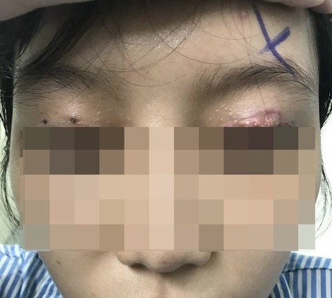 Làm đẹp ở cơ sở thẩm mỹ chui, nhiều phụ nữ tổn thương mắt nghiêm trọng - Ảnh 1. Làm đẹp ở cơ sở thẩm mỹ chui, nhiều phụ nữ tổn thương mắt nghiêm trọng - Ảnh 1.