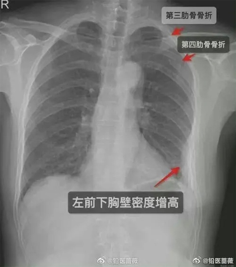 Cô gái bị gãy xương vì đồng nghiệp nam... ôm - Ảnh 1. Cô gái bị gãy xương vì đồng nghiệp nam... ôm - Ảnh 1.