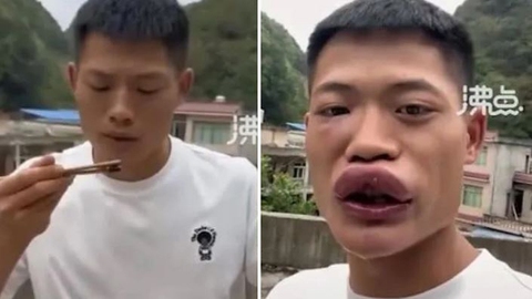 TikToker ăn ong bắp cày còn sống khiến cái miệng bị sưng chù vù - Ảnh 1. TikToker ăn ong bắp cày còn sống khiến cái miệng bị sưng chù vù - Ảnh 1.