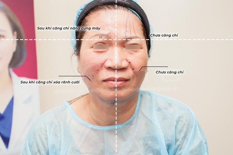 Bác sĩ Nguyễn Phương Thảo giải đáp những điều cần biết về căng da bằng chỉ - Ảnh 2. Bác sĩ Nguyễn Phương Thảo giải đáp những điều cần biết về căng da bằng chỉ - Ảnh 2.