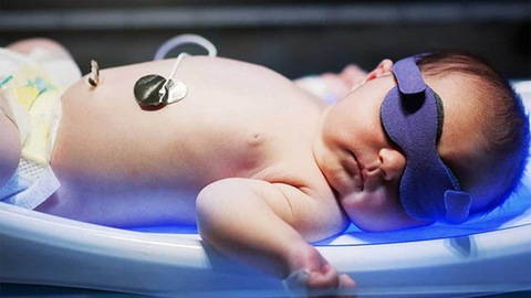 Không nên xem thường tình trạng vàng da sơ sinh ở trẻ - Ảnh 1. Không nên xem thường tình trạng vàng da sơ sinh ở trẻ - Ảnh 1.