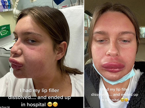 Cô gái trẻ có đôi môi như... thú mỏ vịt sau khi tiêm chất làm tan filler - Ảnh 1. Cô gái trẻ có đôi môi như... thú mỏ vịt sau khi tiêm chất làm tan filler - Ảnh 1.