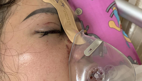 Mù mắt vì tiêm filler nâng mũi tại spa - Ảnh 1. Mù mắt vì tiêm filler nâng mũi tại spa - Ảnh 1.