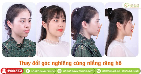 Nha khoa VIET SMILE - Niềng răng mắc cài thấy trước kết quả - Ảnh 1. Nha khoa VIET SMILE - Niềng răng mắc cài thấy trước kết quả - Ảnh 1.