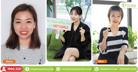 Nha khoa VIET SMILE - Niềng răng mắc cài thấy trước kết quả - Ảnh 3. Nha khoa VIET SMILE - Niềng răng mắc cài thấy trước kết quả - Ảnh 3.