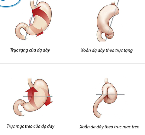 Bé gái 3 tuổi xoắn dạ dày 180 độ hiếm gặp - Ảnh 1. Bé gái 3 tuổi xoắn dạ dày 180 độ hiếm gặp - Ảnh 1.