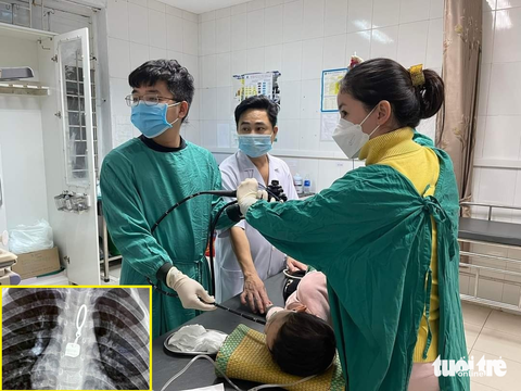 Tá hỏa đưa con 40 tháng tuổi đến bệnh viện khi phát hiện chiếc khóa áo biến mất - Ảnh 1. Tá hỏa đưa con 40 tháng tuổi đến bệnh viện khi phát hiện chiếc khóa áo biến mất - Ảnh 1.
