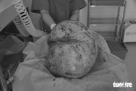 Cắt bỏ hai khối u buồng trứng ‘khổng lồ’ nặng hơn 18 kg cho người phụ nữ 31 tuổi - Ảnh 2. Khối u nang buồng trứng nặng hơn 16kg được các bác sĩ lấy ra từ bụng nạn nhân - Ảnh: Bệnh viện cung cấp