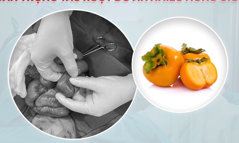 Nhiều người tắc ruột, mắc bệnh ... vì ăn quả hồng sai cách - Ảnh 2. Điều trị cho bệnh nhân tắc ruột do ăn hồng tại Nghệ An - Ảnh: BVCC