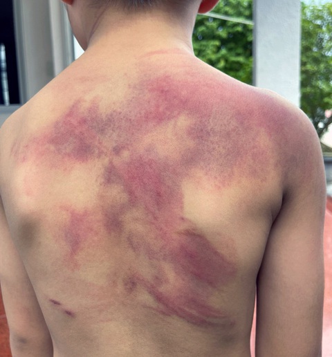 Khởi tố cha ruột đánh con trai 5 tuổi chi chít vết thương - Ảnh 3. Lưng bé trai chi chít vết bầm tím do bị cha ruột bạo hành - Ảnh: A.B.