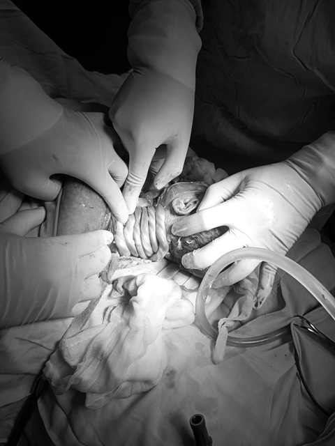 Cháu bé bị dây rốn quấn 6 vòng quanh cổ ra đời an toàn - Ảnh 1. Cháu bé bị dây rốn quấn 6 vòng quanh cổ ra đời an toàn tại Bệnh viện Phụ sản - Nhi Đà Nẵng - Ảnh: QUỲNH MAI