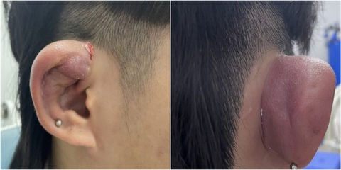 Hình ảnh vành tai bị sưng vù, biến dạng sau khi xỏ khuyên - Ảnh: BVCC Hình ảnh vành tai bị sưng vù, biến dạng sau khi xỏ khuyên - Ảnh: BVCC