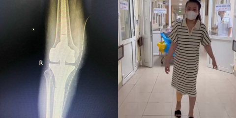 Các bác sĩ đã giữ lại trọn vẹn đôi chân cho bệnh nhân mắc u tế bào khổng lồ xương - Ảnh: BVCC Các bác sĩ đã giữ lại trọn vẹn đôi chân cho bệnh nhân mắc u tế bào khổng lồ xương - Ảnh: BVCC