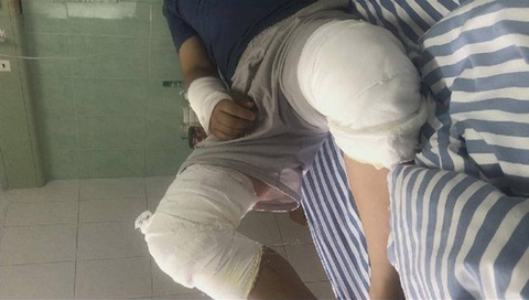 Khâu hơn 100 mũi vì bị lợn rừng xông vào phòng làm việc cắn - Ảnh 1. Ông Lưu bị con lợn rừng cắn bị thương nhiều nơi và phải khâu hơn 100 mũi.