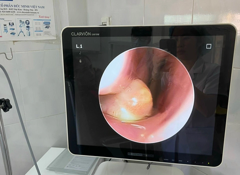 Hi hữu phát hiện cháu bé có răng mọc ngược ở khoang mũi - Ảnh 1. Hình ảnh chiếc răng mọc trong khoang mũi bệnh nhân 4 tuổi - Ảnh: Bệnh viện Nhi Gia Lai