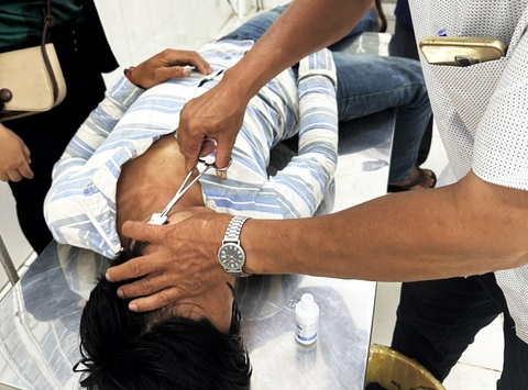 Đã khoanh vùng một số nhóm đối tượng tấn công tàu cá trên biển - Ảnh 2. Anh Nguyễn Văn Đ. bị đạn chì bắn trúng vùng mặt - Ảnh: Người dân cung cấp