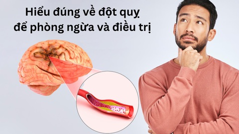 Những lầm tưởng về đột quỵ khiến bạn bỏ qua cơ hội vàng - Ảnh 2. Những lầm tưởng về đột quỵ khiến bạn bỏ qua cơ hội vàng - Ảnh 2.