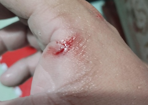 Bị chó cắn, một người đàn ông TP Hà Tiên nghi bị dại - Ảnh 1. Tay của anh P. bị chó cắn - Ảnh: D.THÀNH