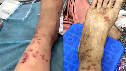 Viêm mao mạch hoại tử, bệnh tự miễn dễ chẩn đoán nhầm- Ảnh 1. Hình ảnh chân của chị Thanh bị viêm mao mạch hoại tử - Ảnh: BNCC