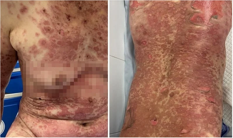 Tổn thương da bọng nước, trợt da, hoại tử thẫm màu vùng ngực lưng của bệnh nhân nữ sau dùng thuốc nam điều trị bệnh sỏi thận - Ảnh: BVCC Tổn thương da bọng nước, trợt da, hoại tử thẫm màu vùng ngực lưng của bệnh nhân nữ sau dùng thuốc nam điều trị bệnh sỏi thận - Ảnh: BVCC
