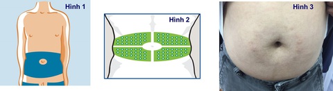Gần 70% người đái tháo đường tiêm insulin sai, nhiều người phải cấp cứu- Ảnh 2. Hình minh họa - BSCC