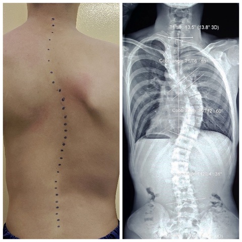 Nhiều học sinh cong vẹo cột sống: Khám định kỳ giúp phát hiện sớm- Ảnh 1. Hình ảnh X-quang cho thấy cột sống của một bạn trẻ bị vẹo hình chữ S rất nặng - Ảnh: Bác sĩ cung cấp