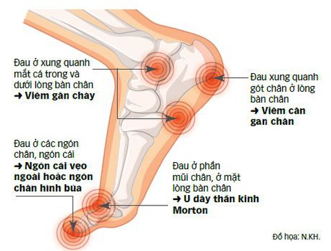 Vì sao bị đau bàn chân, xử lý ra sao?- Ảnh 2. Vì sao bị đau bàn chân, xử lý ra sao?- Ảnh 2.