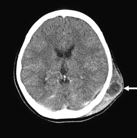 Hình CT áp xe da đầu - Ảnh: SCIENCE DIRECT Hình CT áp xe da đầu - Ảnh: SCIENCE DIRECT